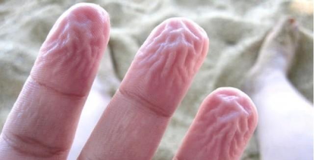 为什么手指泡水后凹凸不平,手指泡水后变腐烂怎么办