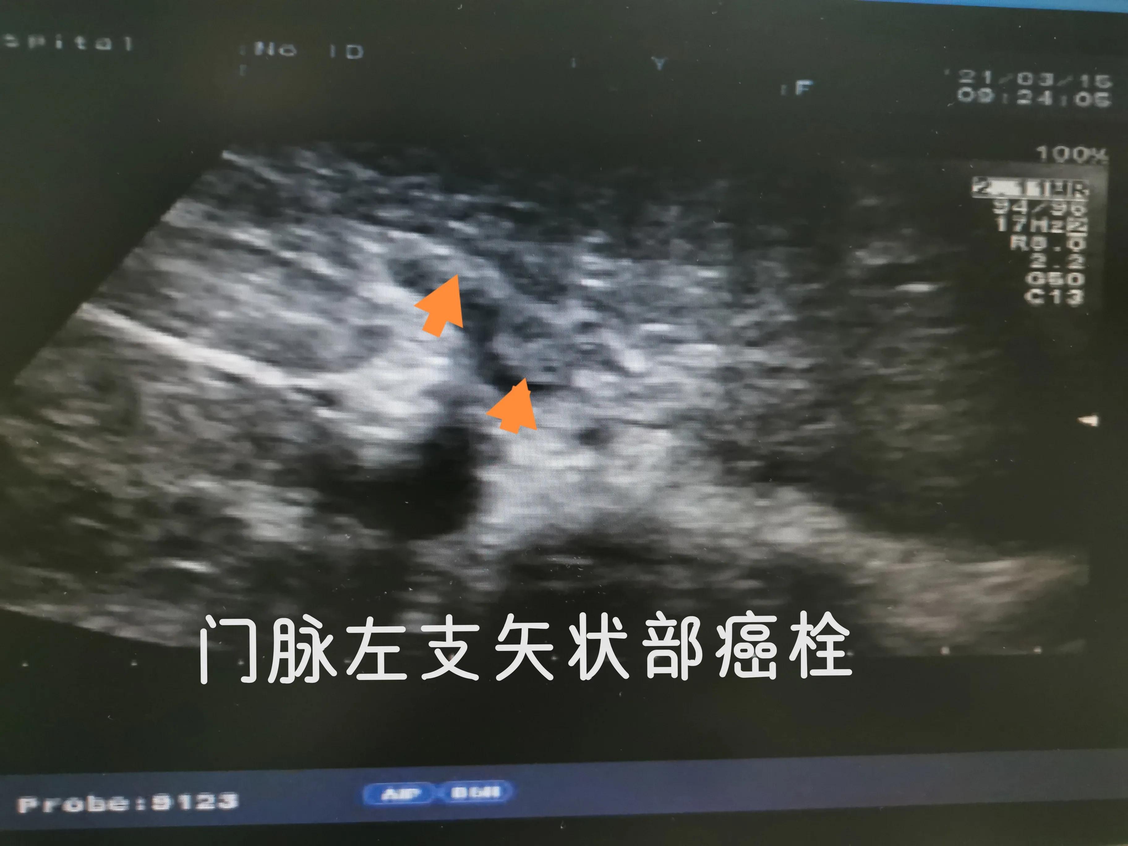 乙肝肝硬化和丙肝肝硬化的区别,乙肝肝硬化肝部占位是肝癌吗