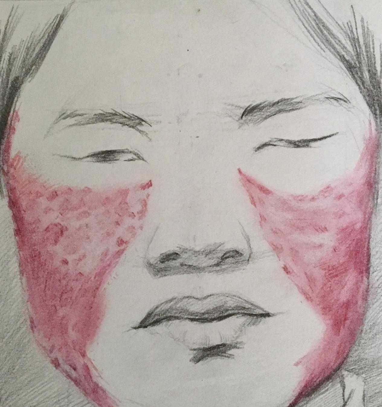 脸红肿掉头发口腔溃疡是什么病,脸长溃疡