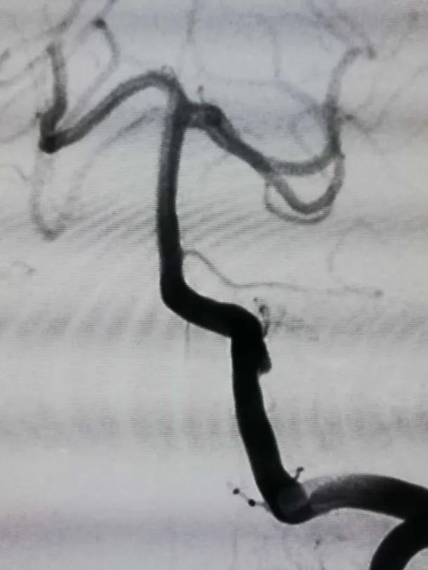 淄博市中心医院治疗动脉瘤,tubridge动脉瘤支架医保报销多少