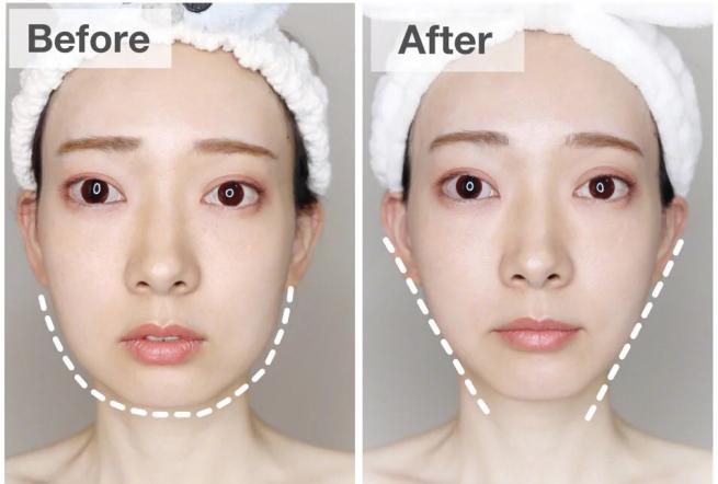 美容面部紧致提拉全过程,怎么做面部提拉改变大小脸