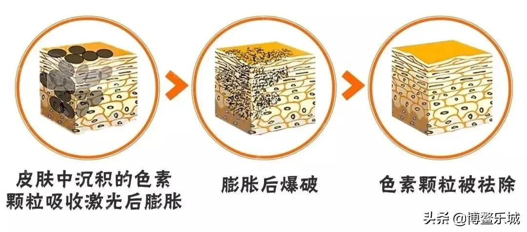 平价家用激光祛斑仪测评,世界顶级激光祛斑仪