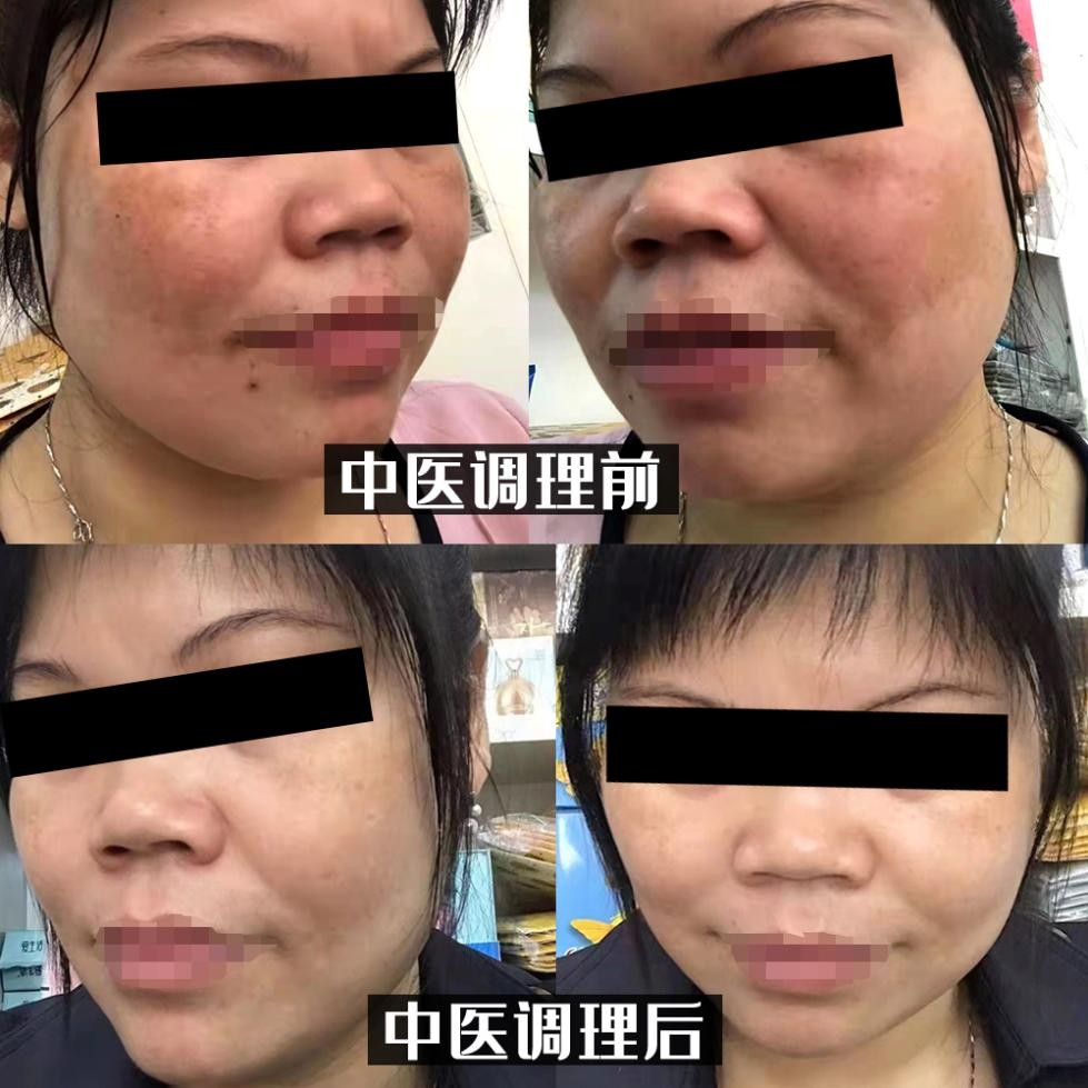 褐斑是怎么引起的,怎么预防长褐斑