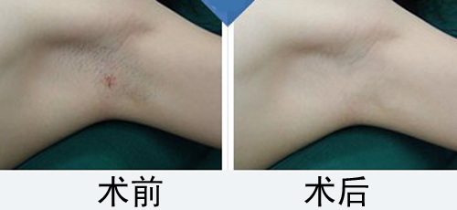 微创治疗腋臭大概多少钱,目前治疗腋臭的最好手术方法