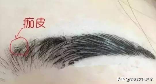 结痂是掉得越晚恢复越好吗,结痂最快的恢复办法