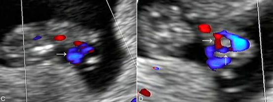 妇科超声和早孕超声有什么区别,明明白白做b超