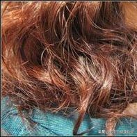 脱发联合治疗方案,脱发斑秃吃黄金搭档管用吗