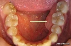 牙骨突出嘴也凸怎么办,牙槽不平怎么办