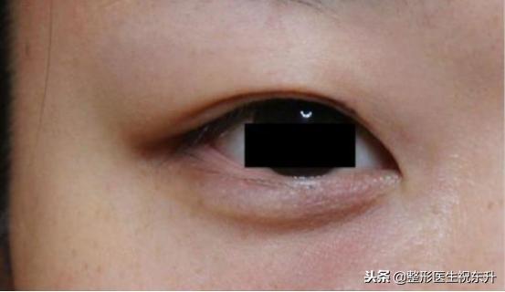 割双眼皮后怎样可以尽快完全恢复,割的双眼皮很不自然要怎么修复呢