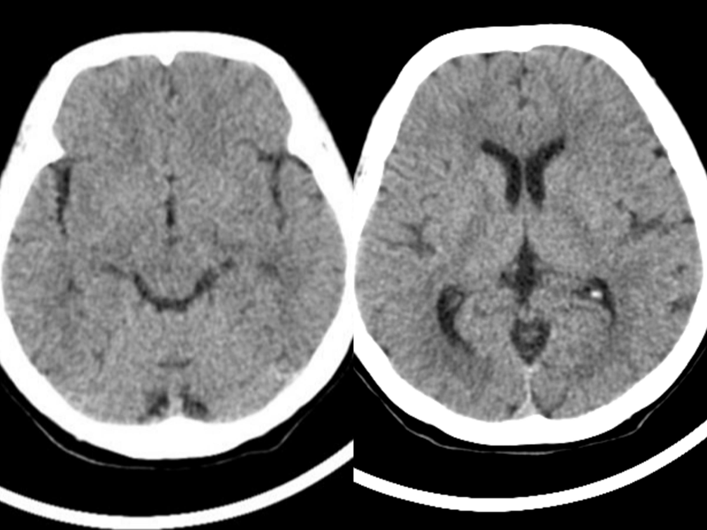 脑萎缩是什么病的征兆,什么叫脑萎缩有哪些症状