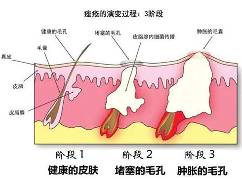 俏肌草本祛痘,俏肌龄祛痘精华液怎么用