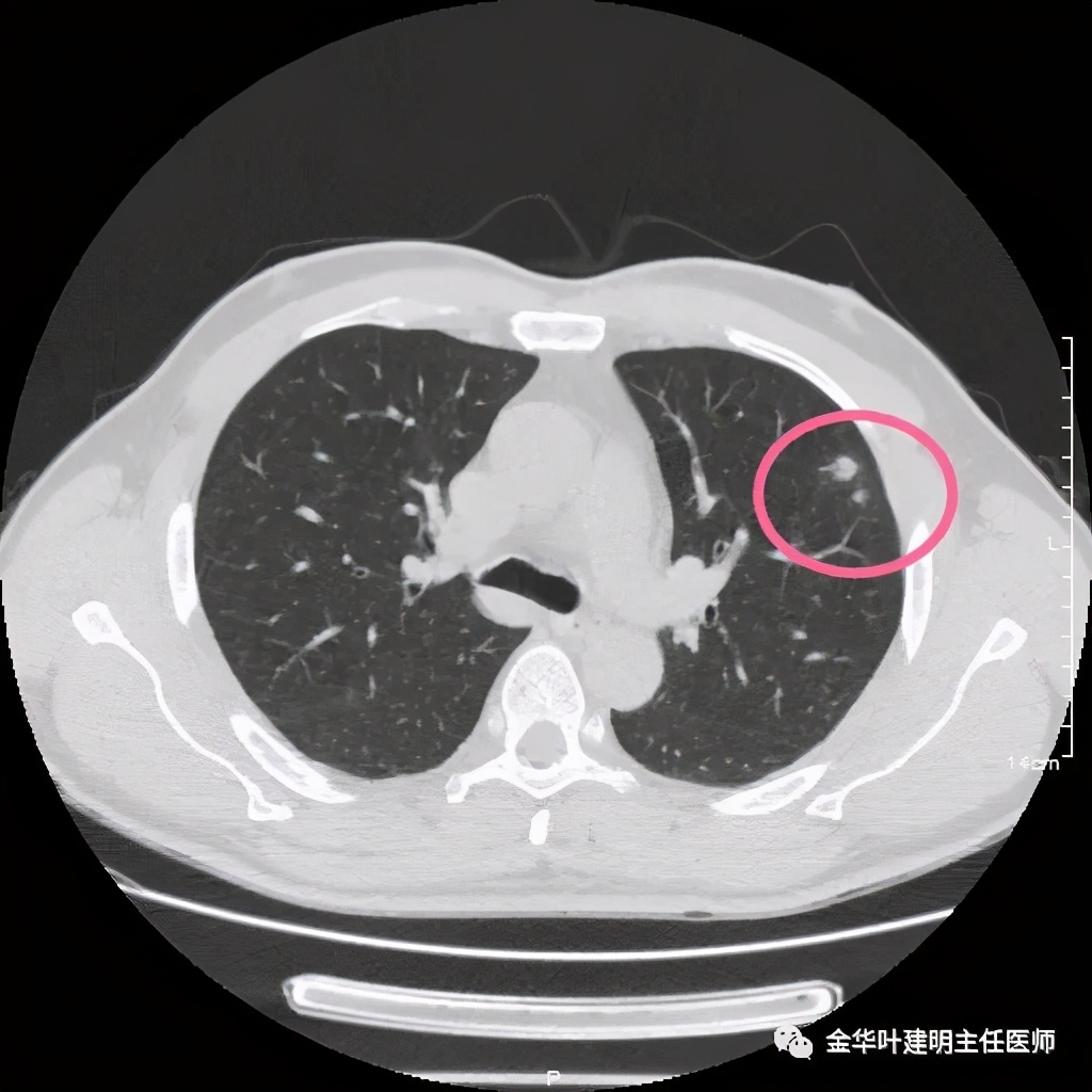 叶建明谈肺结节:一招分辨隐球菌性肉芽肿与肺癌