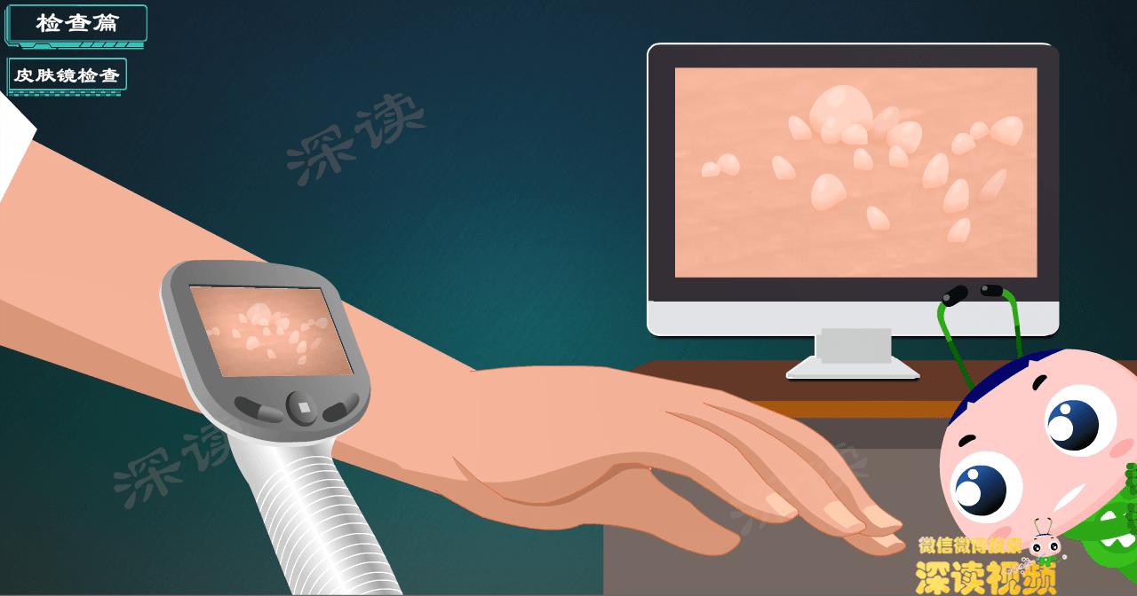 液氮冷冻治疗尖锐湿疣,冷冻和激光治疗尖锐湿疣的效果