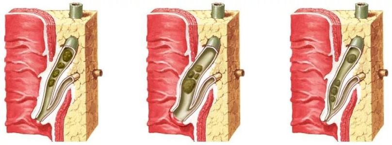 胆囊切除术后肚子胀气是怎么回事,胆囊切除术后综合症忌吃什么药