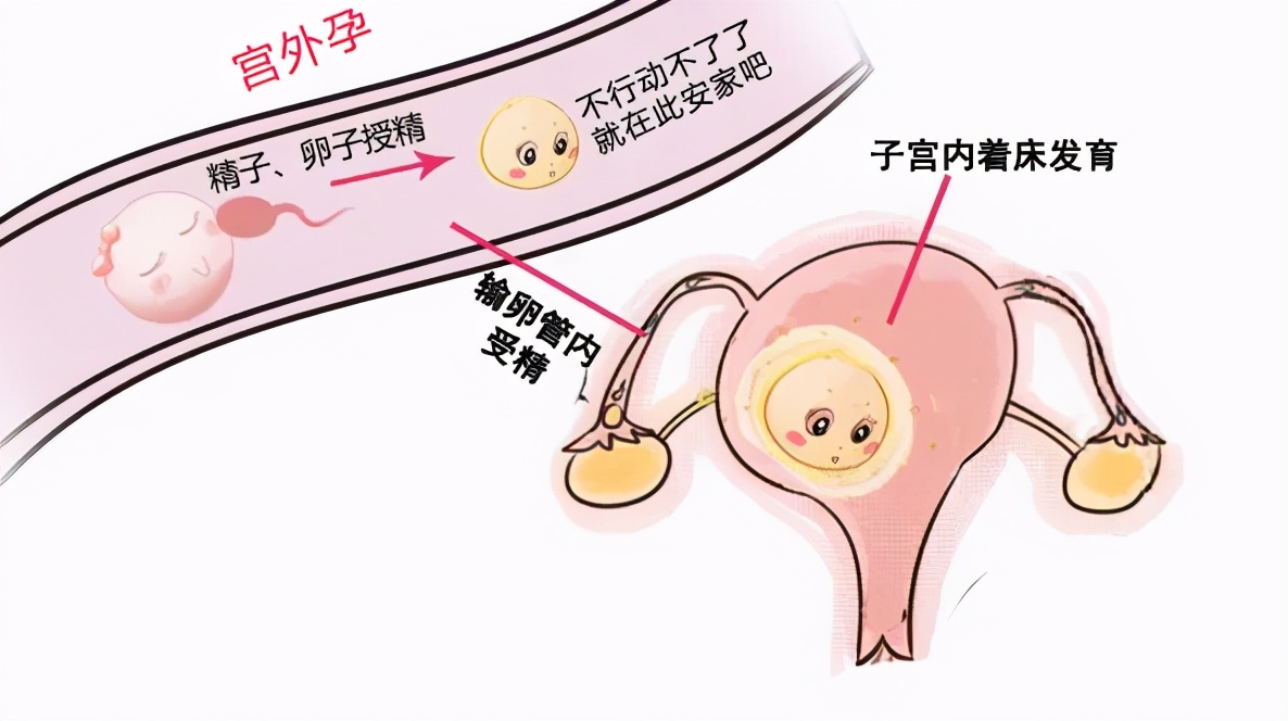 一个输卵管怀孕还会出现宫外孕吗,一个输卵管还会出现宫外孕吗