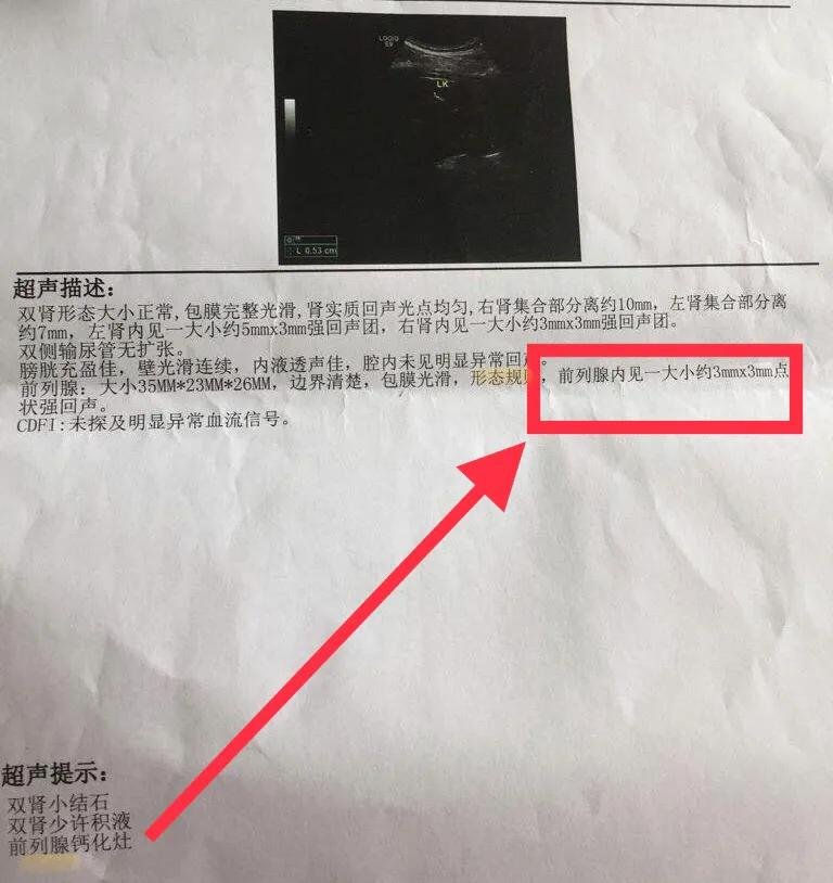 前列腺钙化灶可以用冲击波治疗吗,前列腺钙化灶尿频尿痛怎么治疗