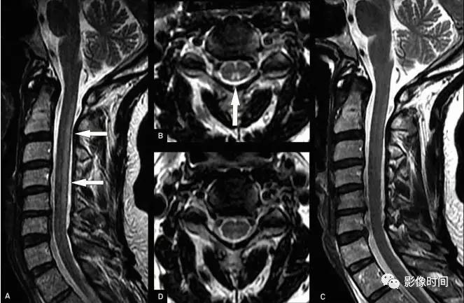 脊髓病变案例图文问诊,脊髓病变视频