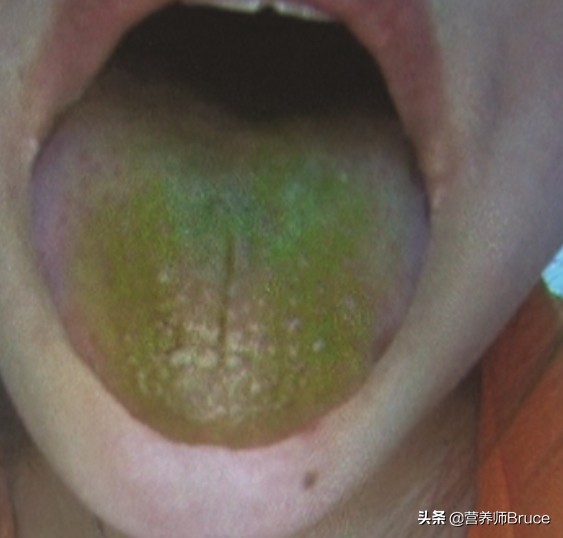 舌头观察身体症状,舌头观察健康状况