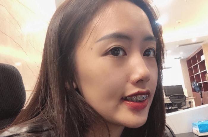 牙套隐形日记,牙套日记正颌