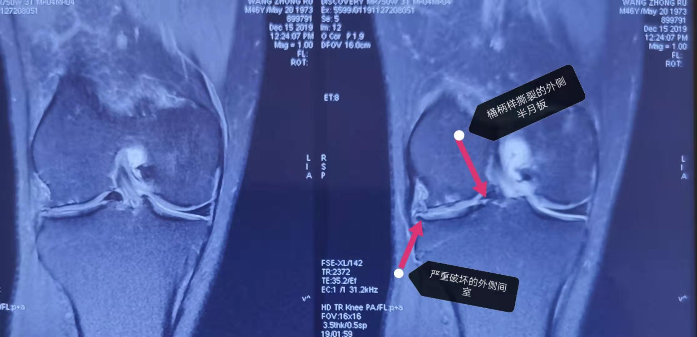 半月板微创手术怕不怕,半月板手术是不是能不做就不做