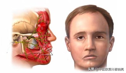 轻微面瘫的10大忌,面瘫最怕的四个误区