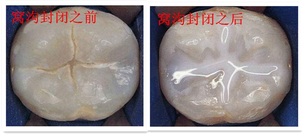 孩子满口蛀牙，又不配合治疗！为了孩子的健康，家长该如何预防？