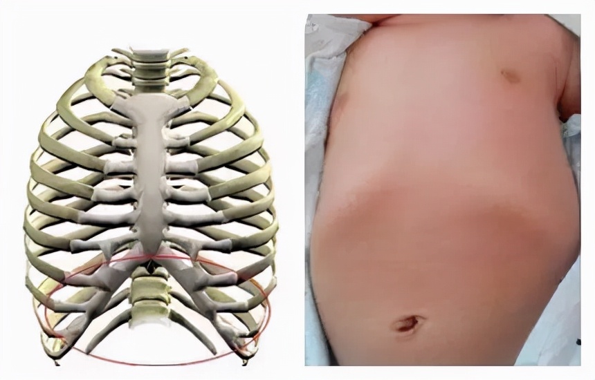 小孩肋骨外翻要不要紧,小孩肋骨外翻用去医院吗