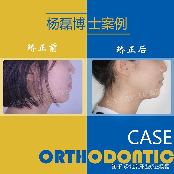 北京牙齿矫正大约要多少钱,北京哪个医院看牙齿矫正比较好