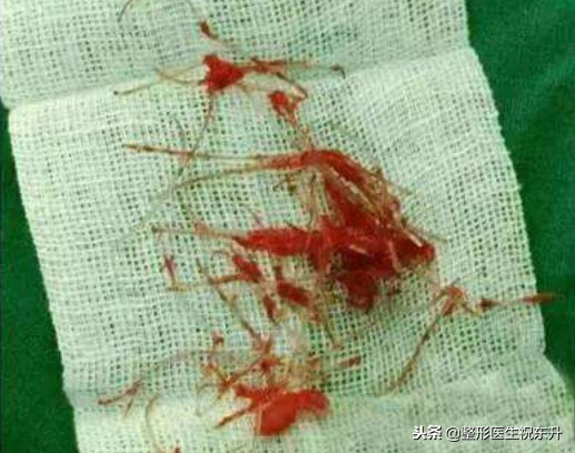 红色预警发出后规定的防范措施,哪些鼻型不适合线雕隆鼻