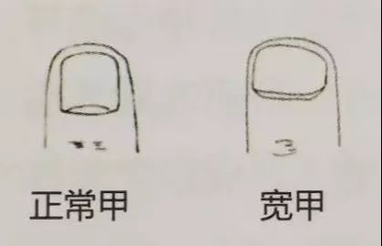 指甲有四种现象很危险,指甲反映身体状况
