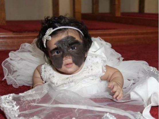 胎记女孩一夜爆红,胎记女孩手术前后对比