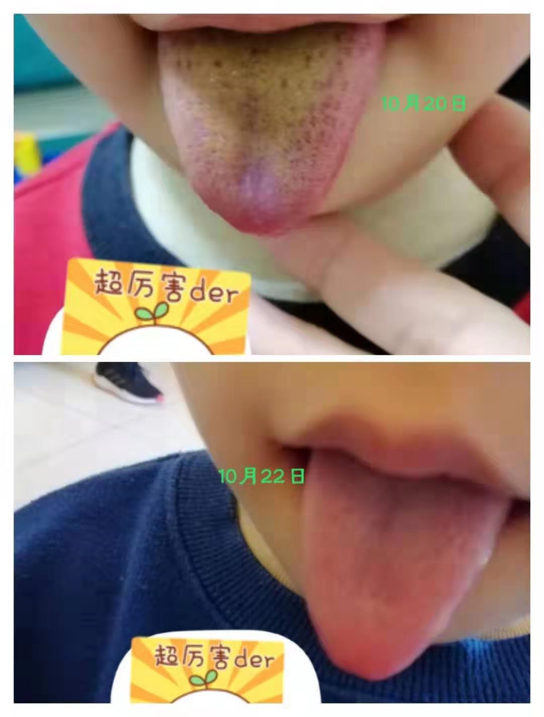 宝宝吃太多导致积食咳嗽,孩子吃得太多咳嗽是怎么回事