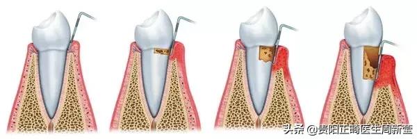 牙齿松动最好的办法解决,牙齿松动怎么办才能治好