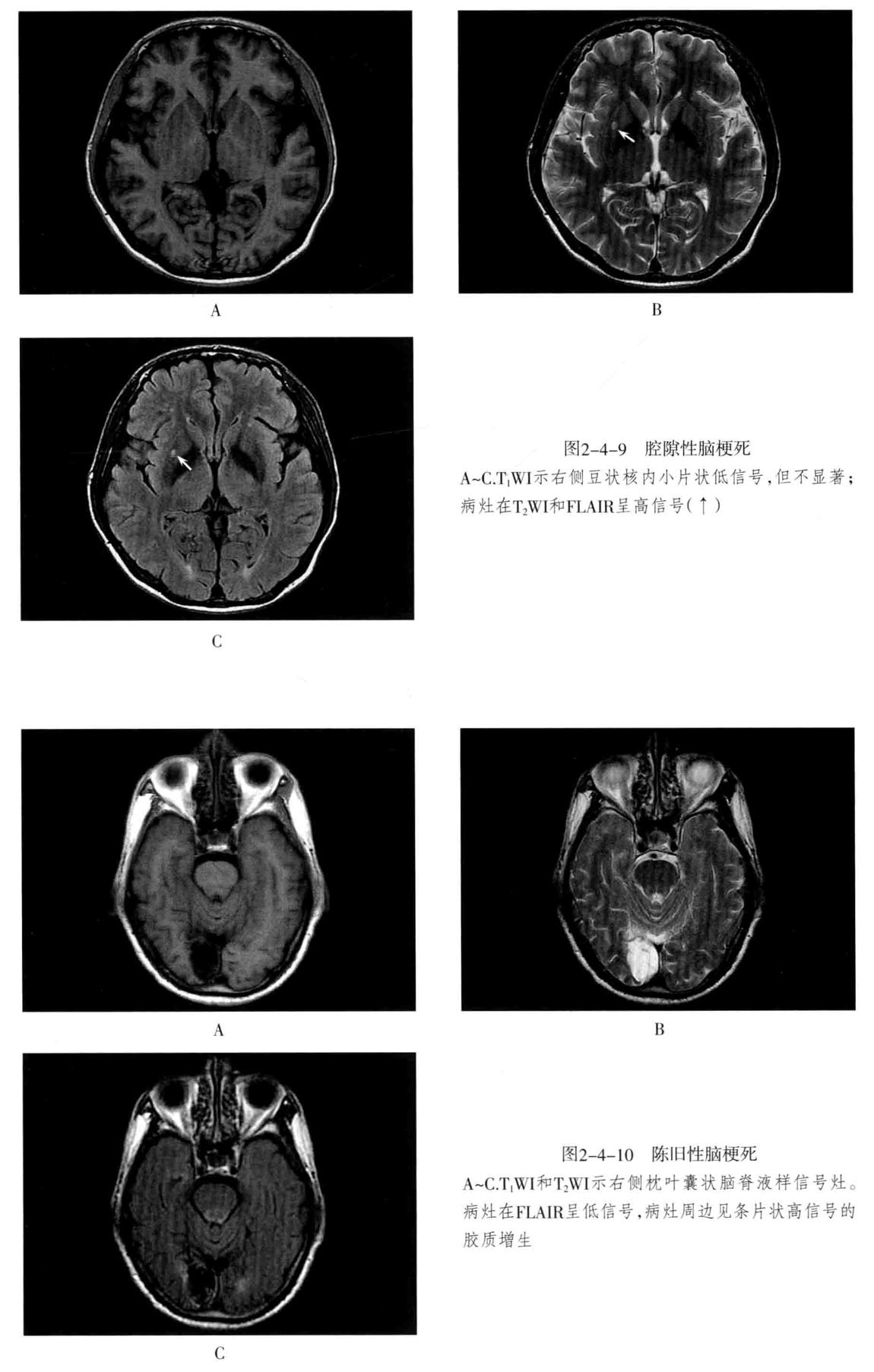 颅内血管周围间隙的影像鉴别,颅脑血管源性疾病影像诊断