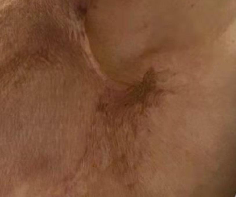 为什么受伤后会留疤？留疤后该怎样处理？