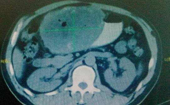 巨型肝癌晚期存活了5年,肝癌10厘米治愈案例