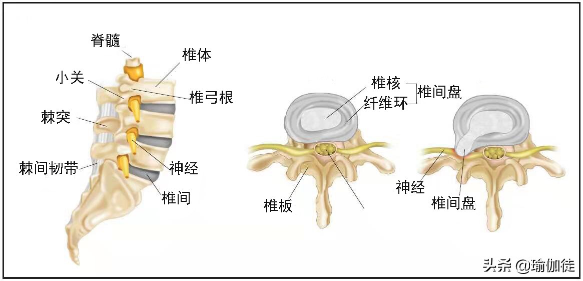 四个步骤，四组不同的轴向伸展序列，以尽量减少对椎间盘的压力