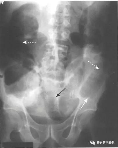 辨识肠梗阻,肠梗阻死亡前兆