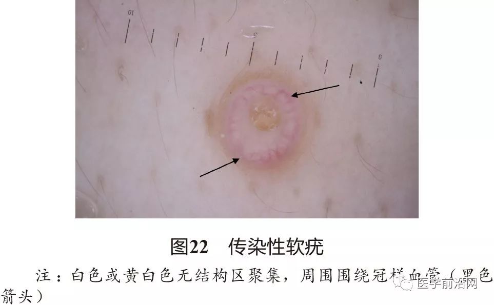 面部常见皮肤病皮肤镜诊断专家共识全文发布