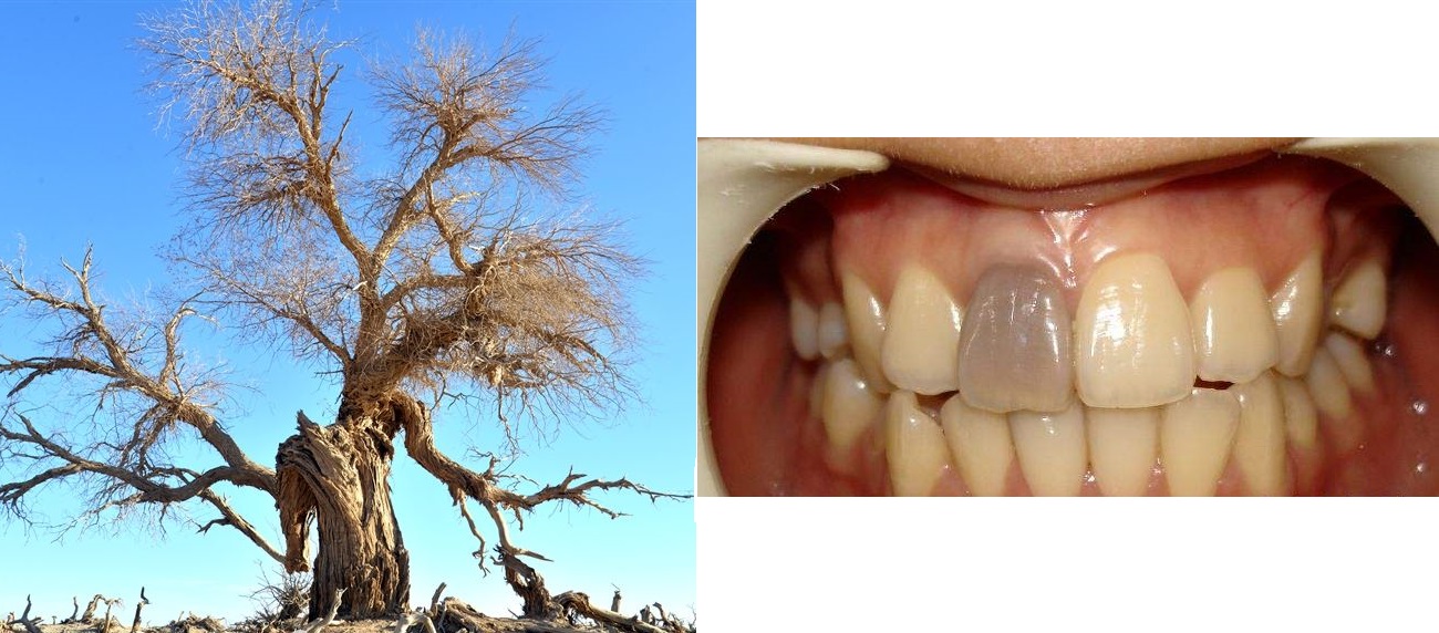 智齿蛀牙痛有什么有效方法止痛,智齿旁边牙松动蛀牙如何处理