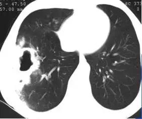 肺部ct十大征象,肺部ct正常图和异常图的区别