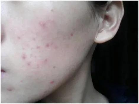 红痘印怎么医学处理,红痘印如何消除最快方法