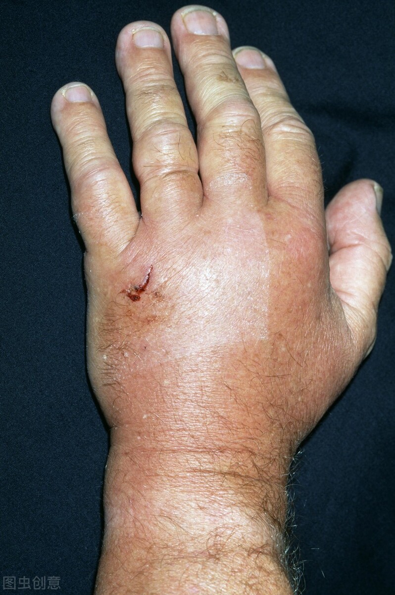 福建女子被蛇咬后续,福建女子被狗咬伤视频