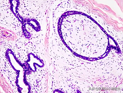 乳腺纤维腺瘤很简单，但特殊类型会癌变