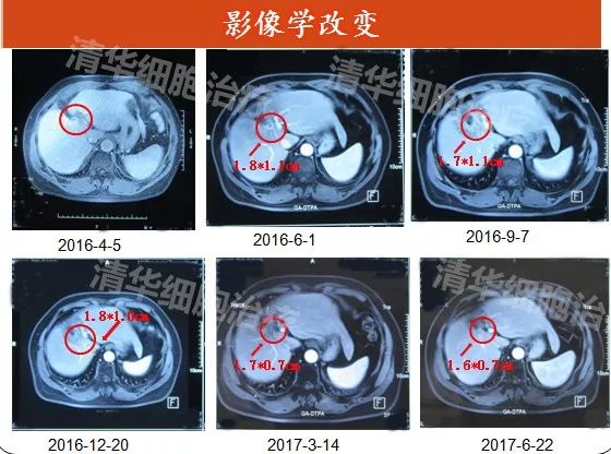 硼中子治疗癌症复发几率多高,癌症术后复发几率