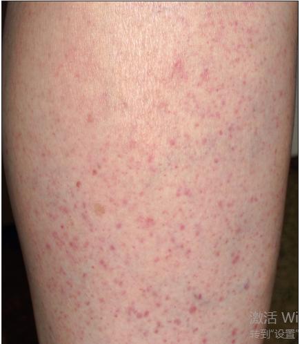 干燥综合征是什么样的症状,干燥综合征是什么样的