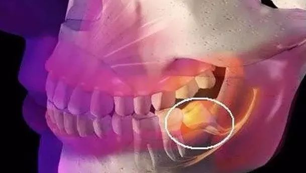 口腔智齿,智齿拔除后怎么处理智齿