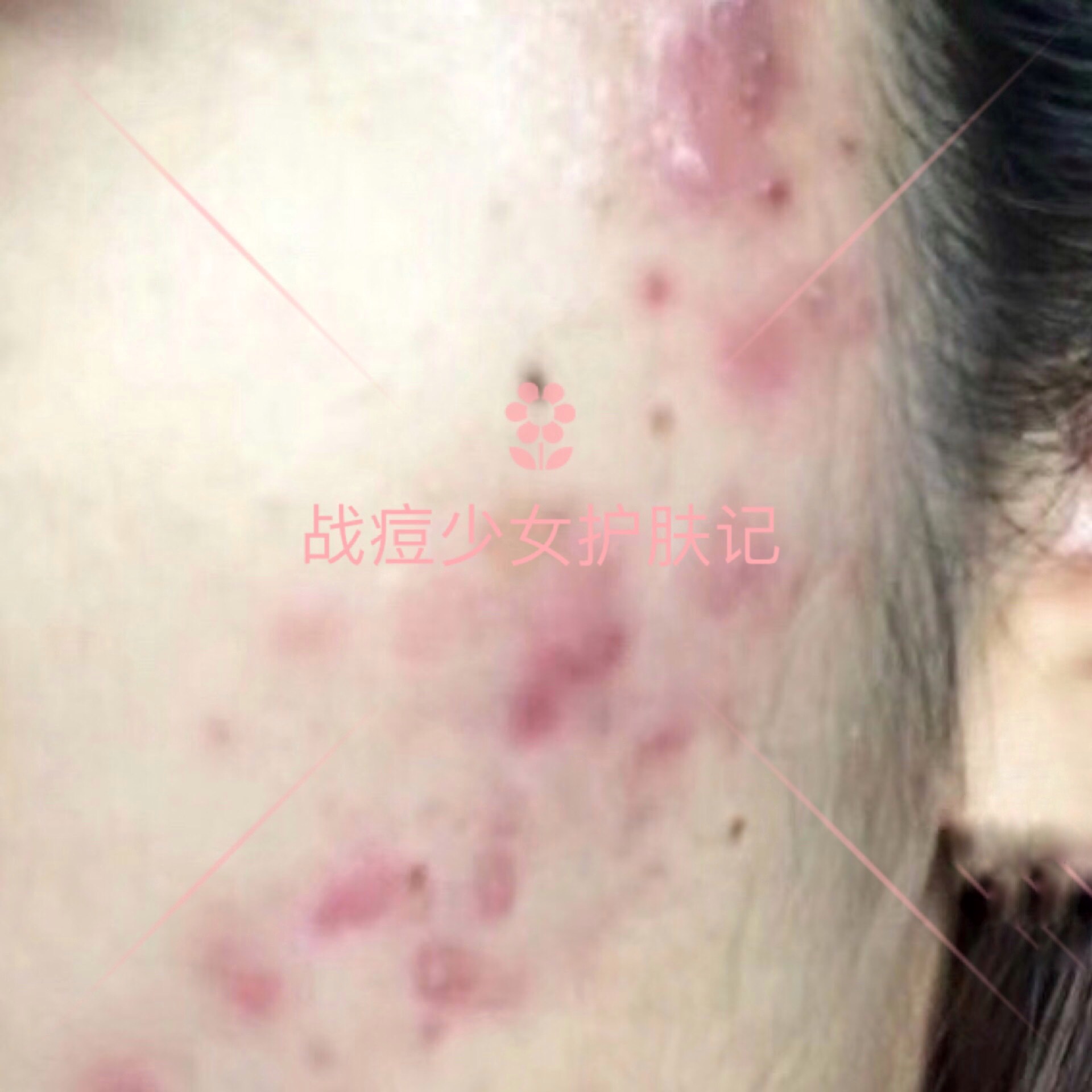 6种痘痘对号入座，1分钟教会你认清痘痘类型，对症战痘！