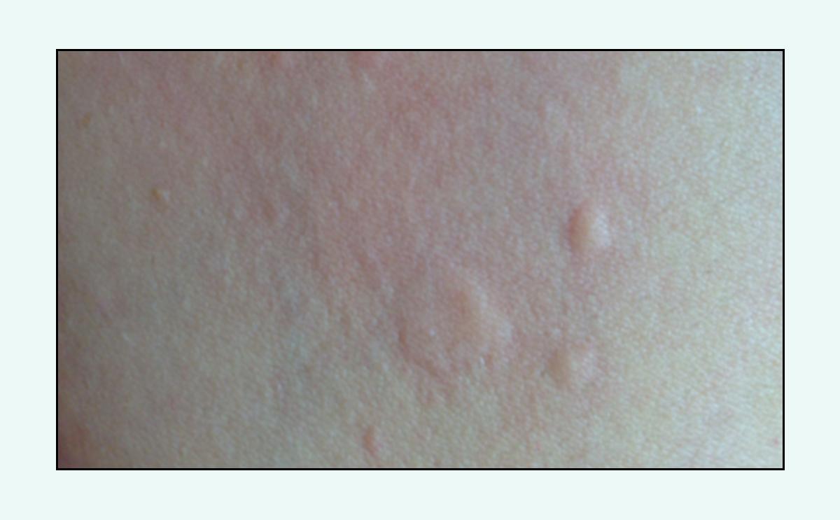 脸上的红疙瘩怎么彻底消除,脸上红疙瘩的种类