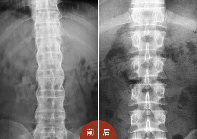 强直早期发现可怕吗,现在30岁得强直可怕吗